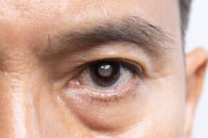 Senior man with developing cataracts, in need of intraocular lens replacement