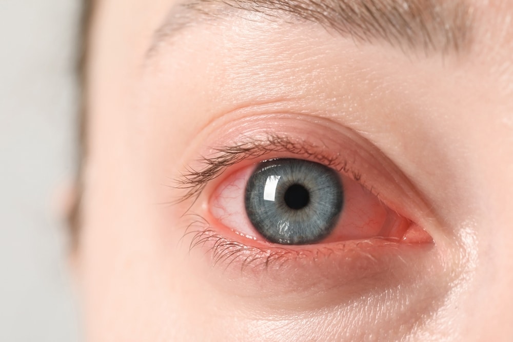 Close up of a person's eye, suffering from conjunctivitis or "pink eye." Close up of a person's eye, suffering from conjunctivitis or "pink eye."